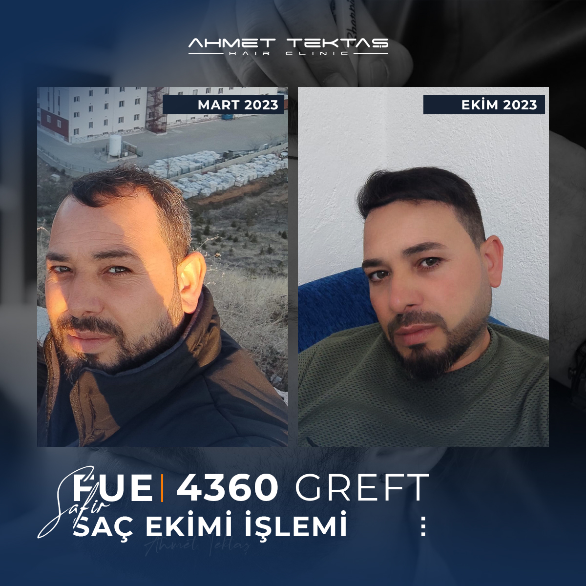 Kayseri Saç Ekimi, Erdi Bey Kayseri Saç Ekimi, Erdi Bey