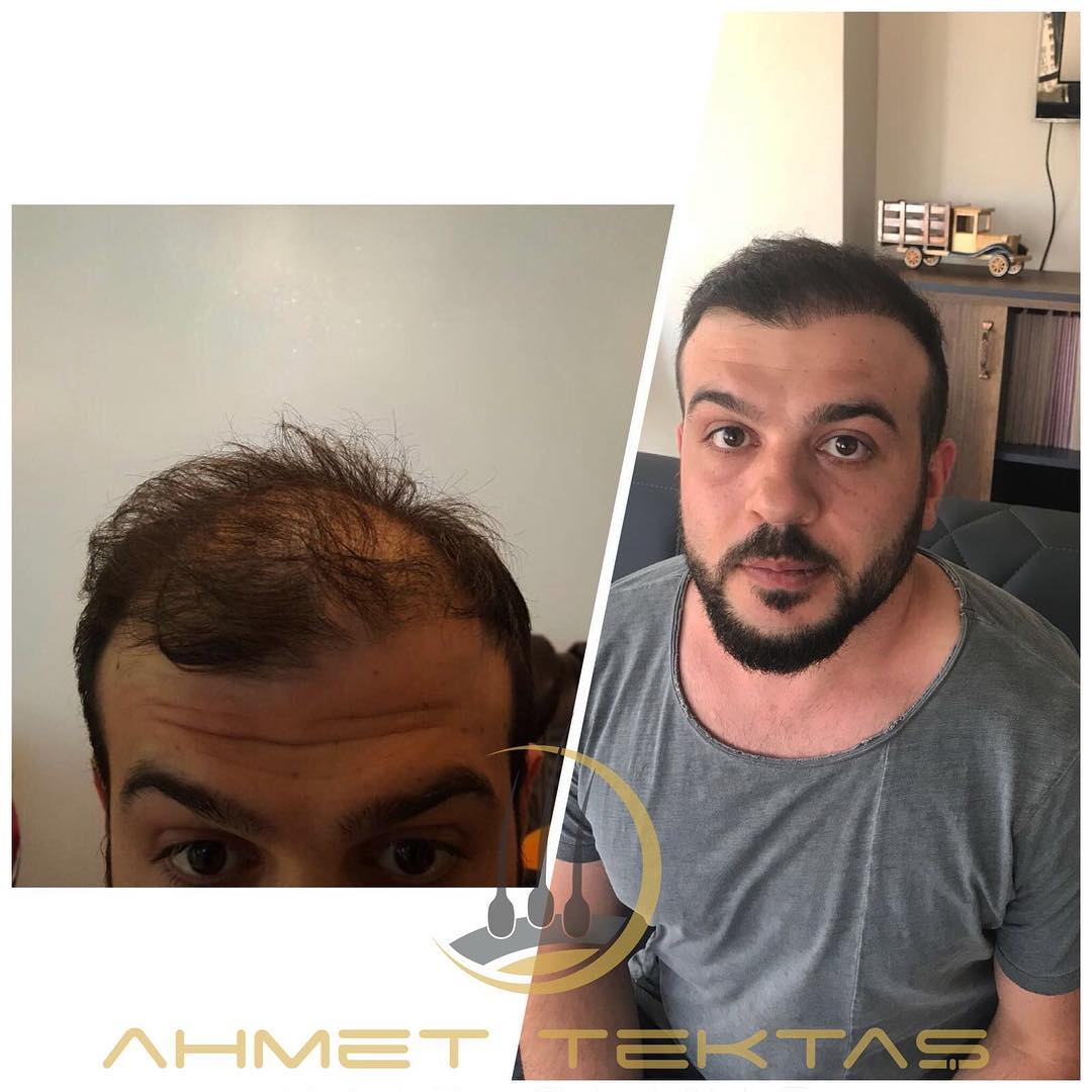 Kayseri Saç Ekimi, Mustafa Bey Kayseri Saç Ekimi, Mustafa Bey