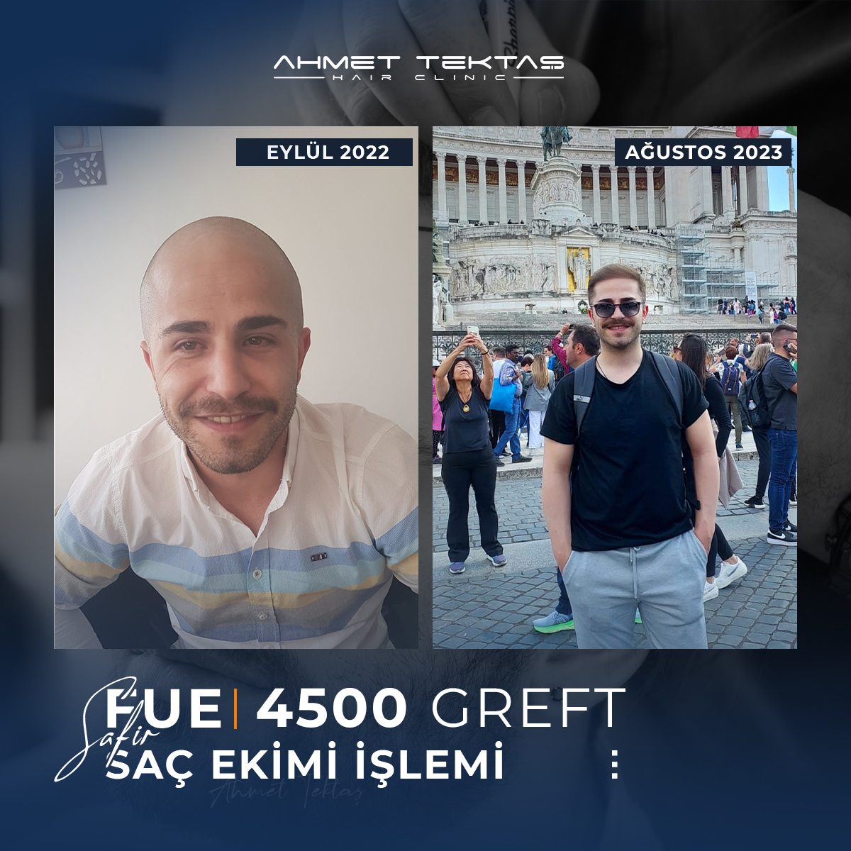 Kayseri Saç Ekimi, Muzaffer Bey Kayseri Saç Ekimi, Muzaffer Bey