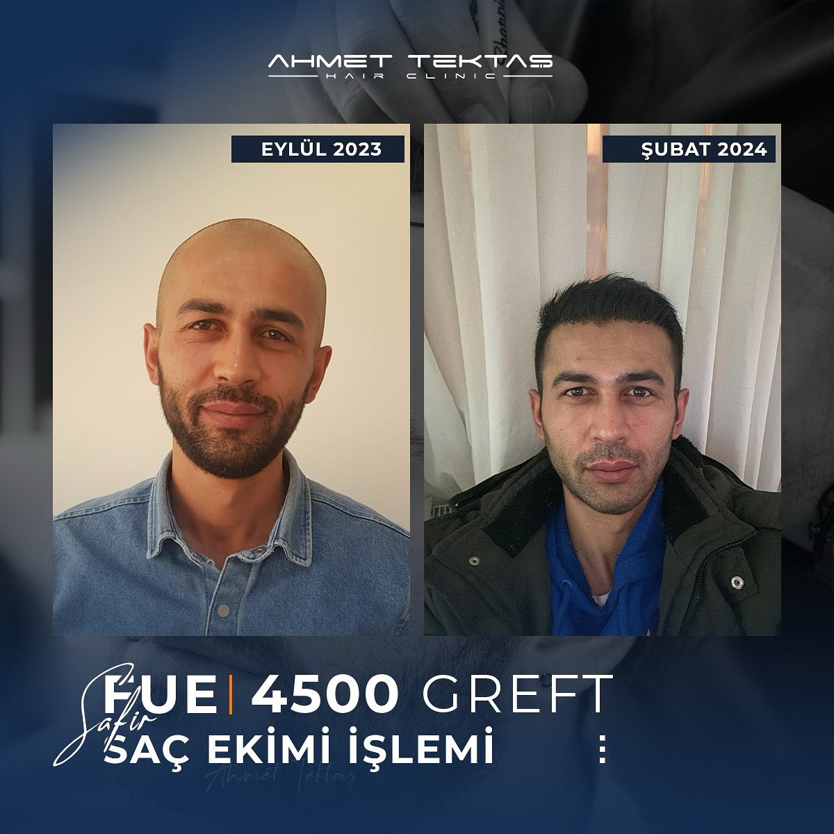 Kayseri Saç Ekimi, Recep Bey Kayseri Saç Ekimi, Recep Bey