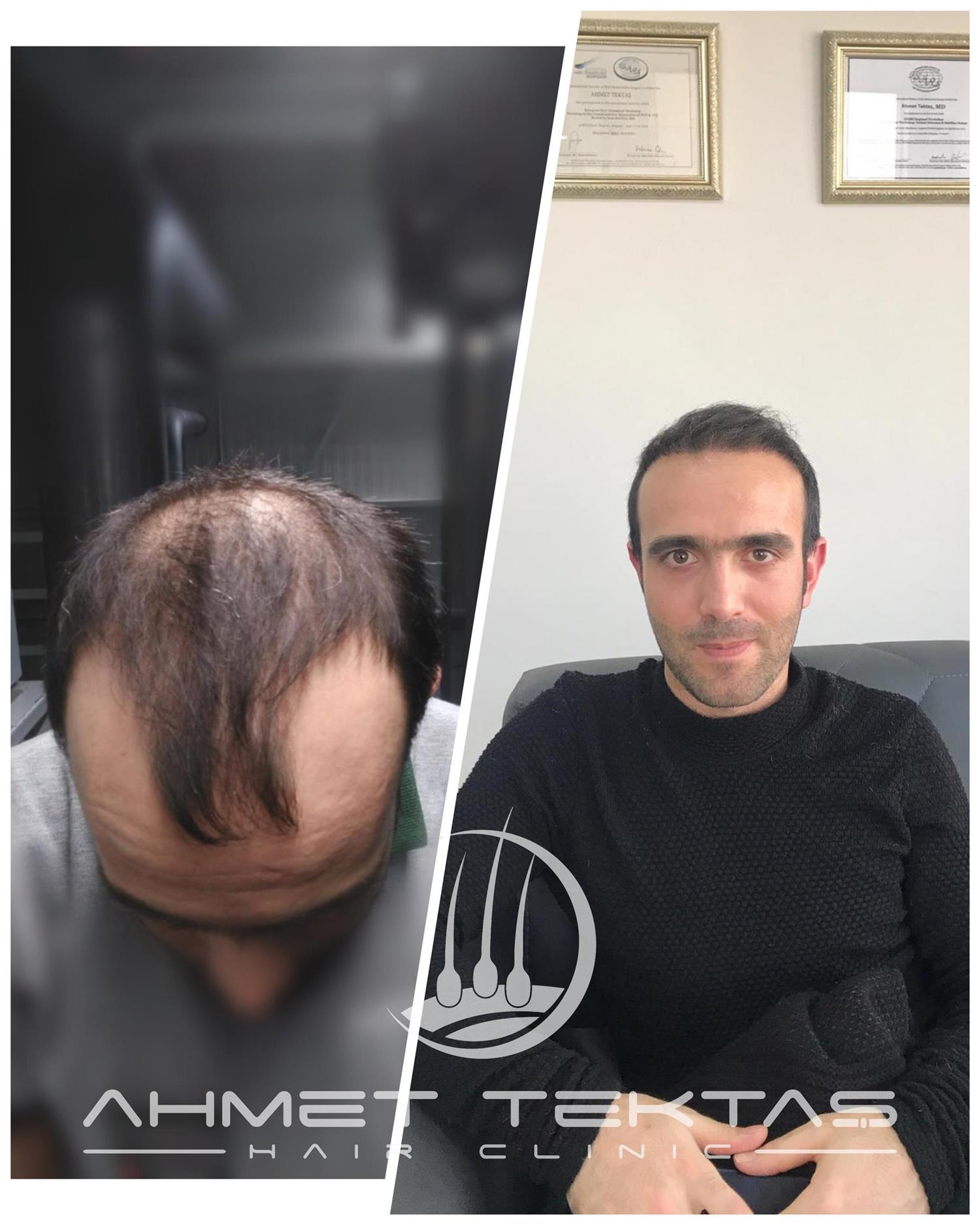 Kayseri Saç Ekimi, Uğur Bey Kayseri Saç Ekimi, Uğur Bey
