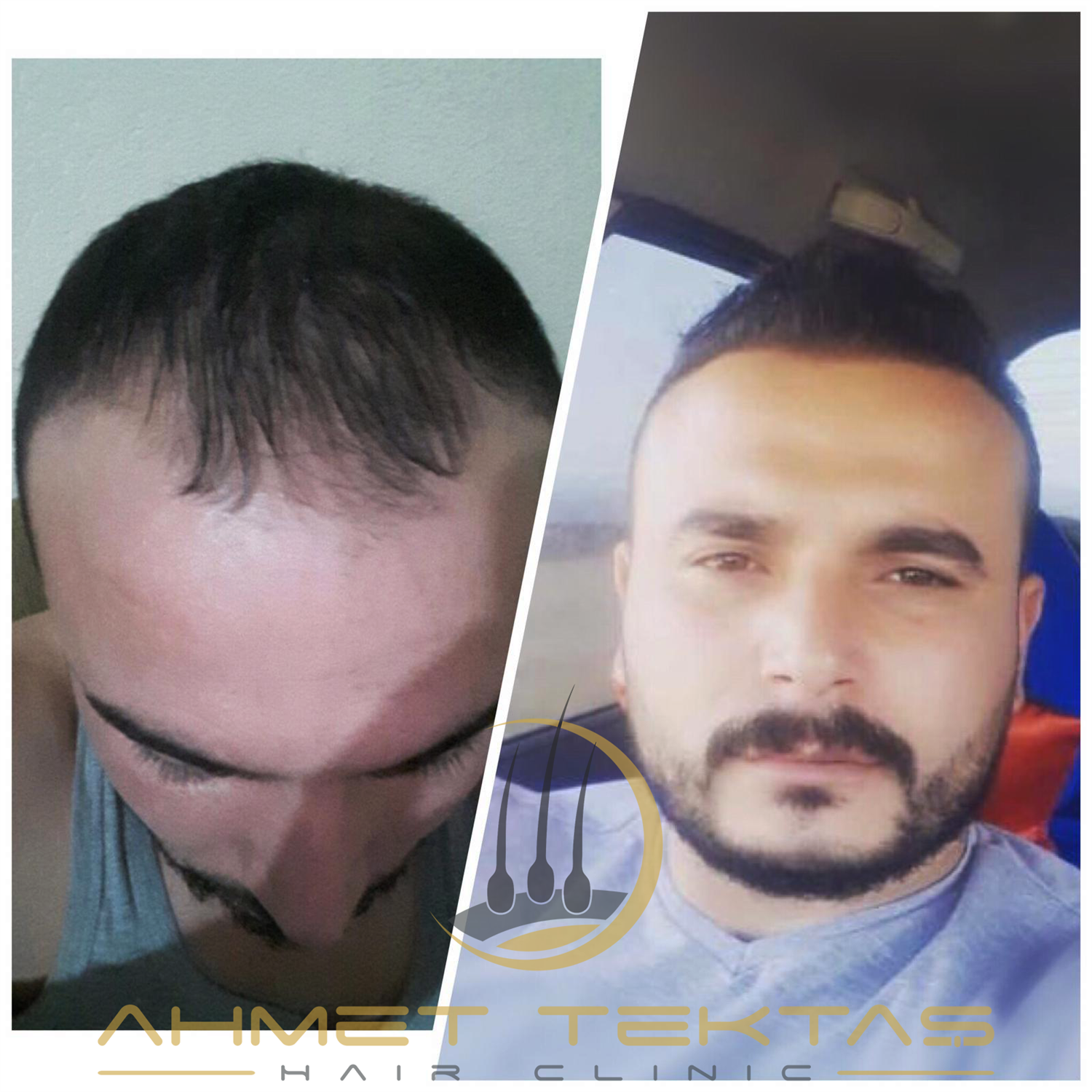 Kırşehir Saç Ekimi, Emre Bey Kırşehir Saç Ekimi, Emre Bey