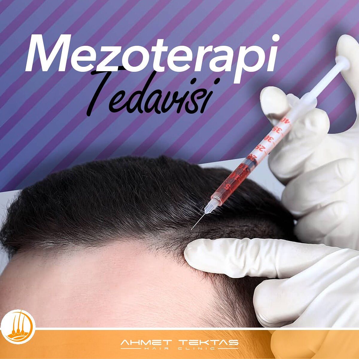 Saç Mezoterapisi Saç Mezoterapisi