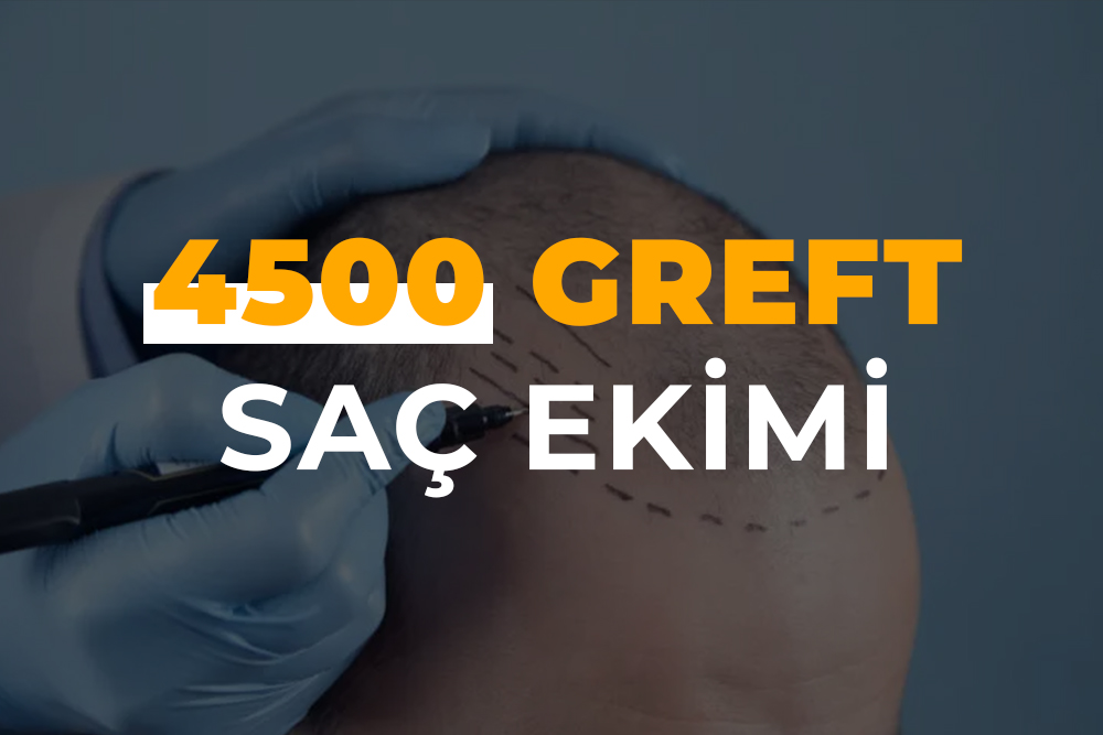 4500 Greft Saç Ekimi (4500 Kök Saç Ekimi )