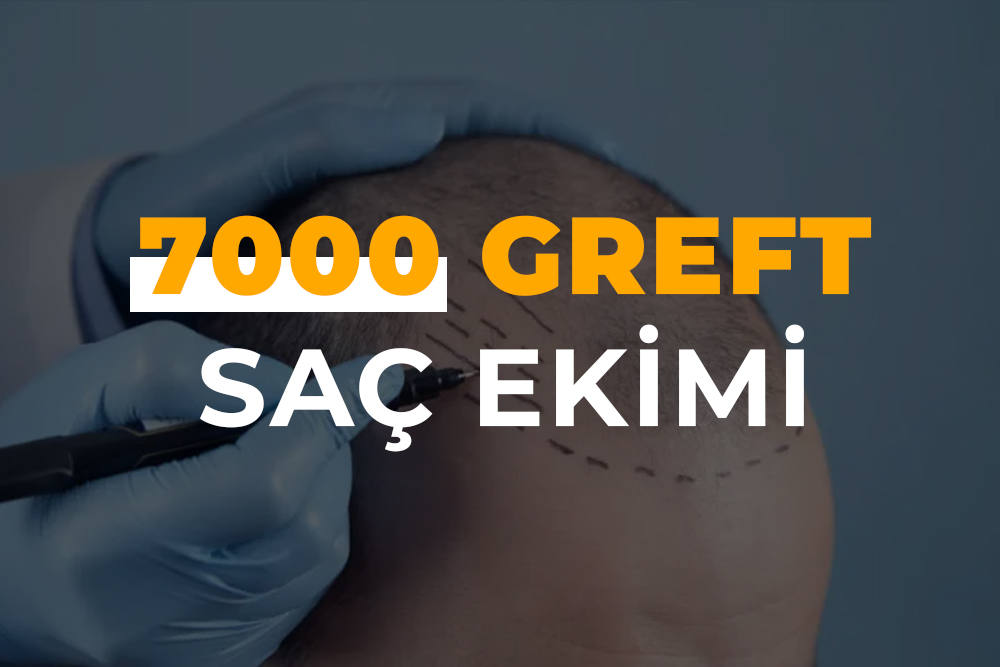 7000 Greft Saç Ekimi (7000 Kök Saç Ekimi )