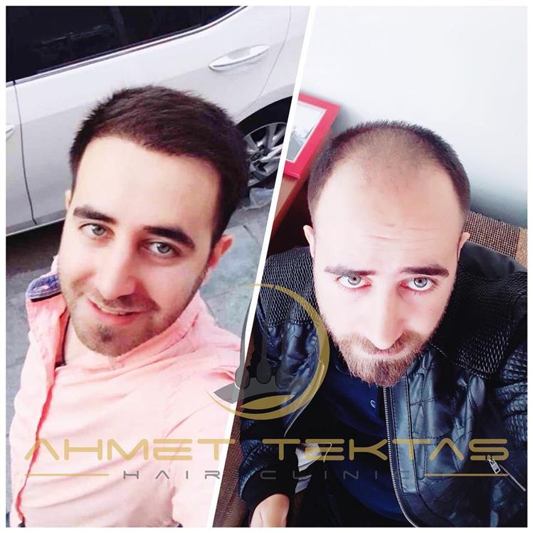 Kahramanmaraş Saç Ekimi, Ömer Bey
