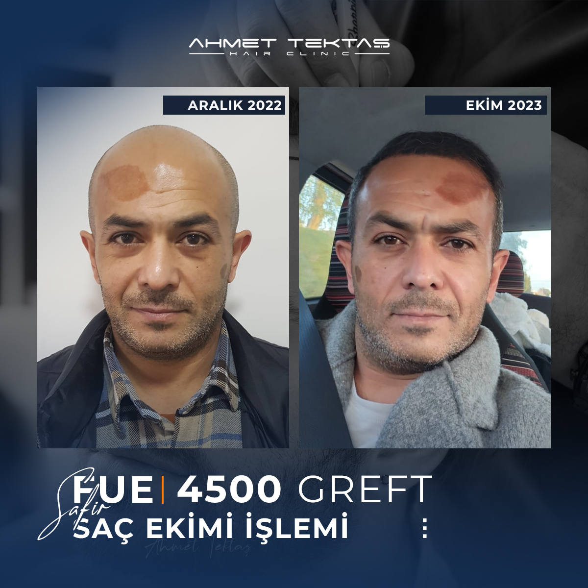 Kayseri Saç Ekimi, Arif Bey