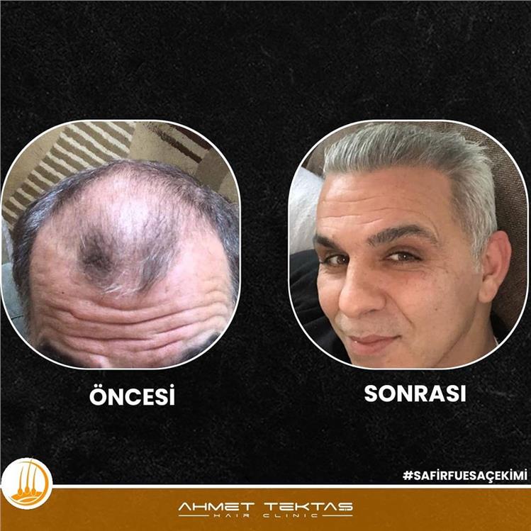 Kayseri Saç Ekimi, Kadir Beyy