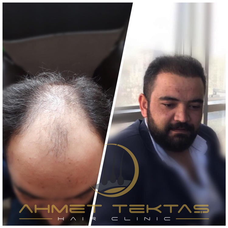 Kayseri Saç Ekimi, Kenan Bey