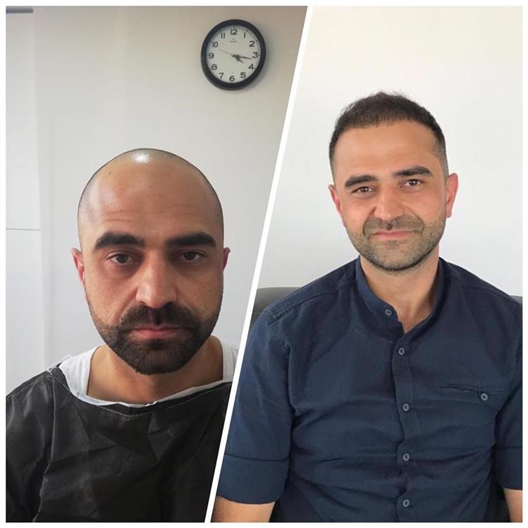 Kayseri Saç Ekimi, Mevlüt Bey