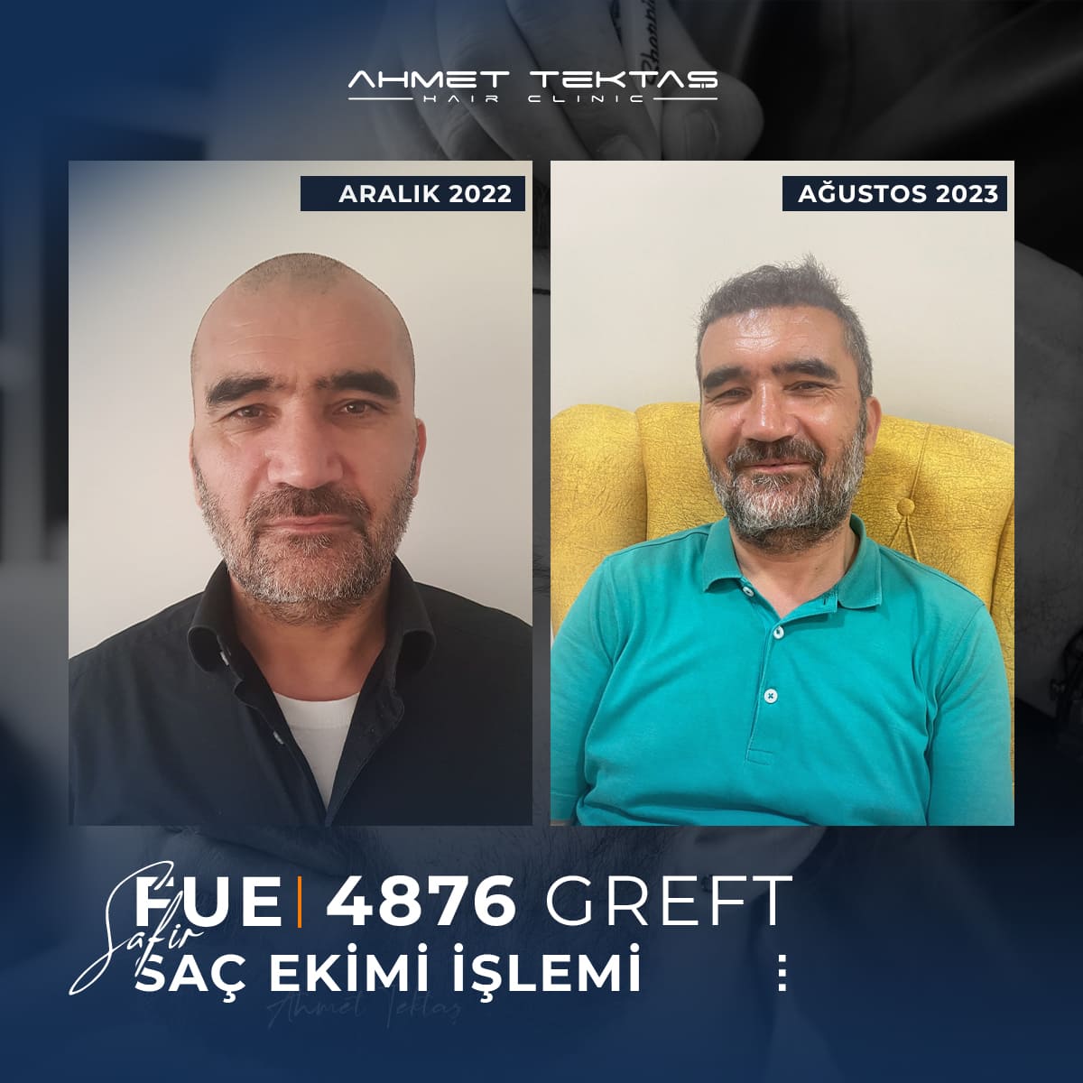 Kayseri Saç Ekimi, Muharrem Bey