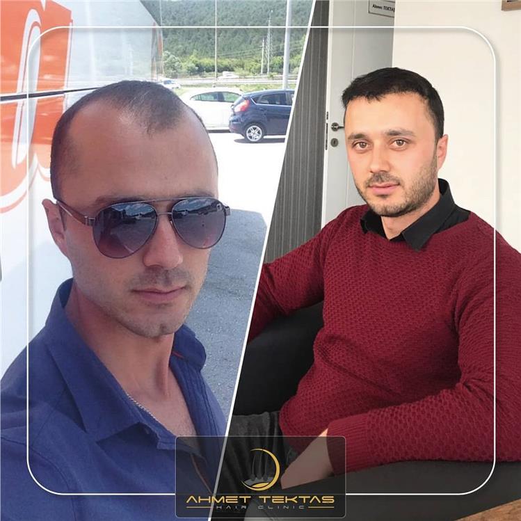 Kayseri Saç Ekimi, Ömer Bey