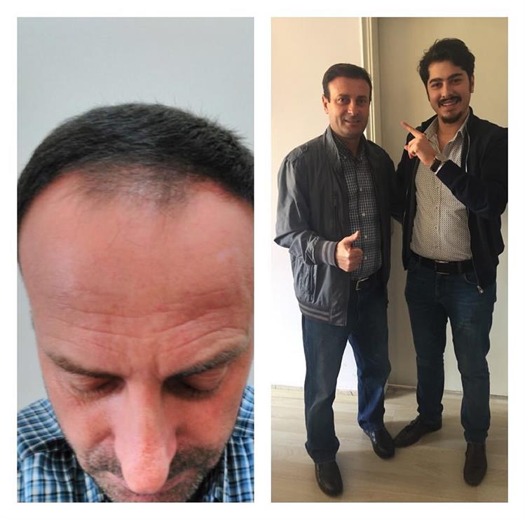 Kayseri Saç Ekimi, Osman Bey