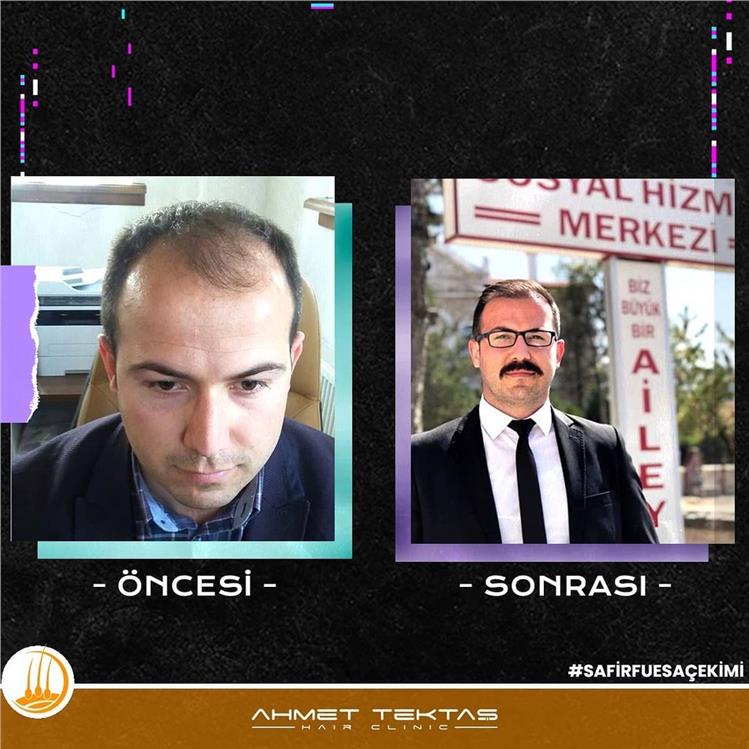 Kayseri Saç Ekimi, Safa Bey