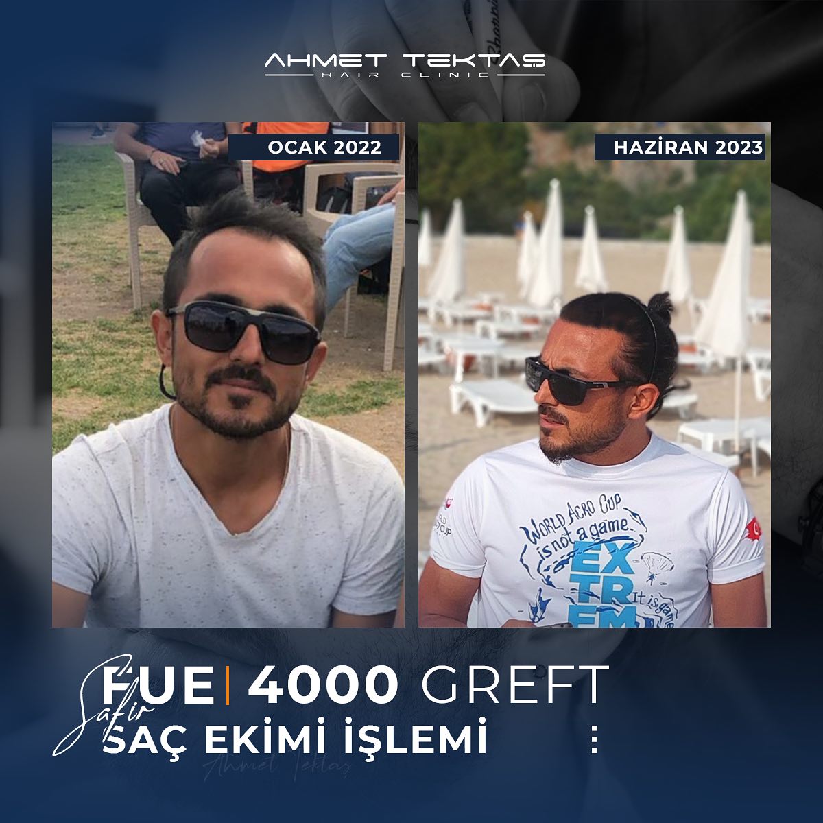 Kayseri Saç Ekimi, Samet Bey