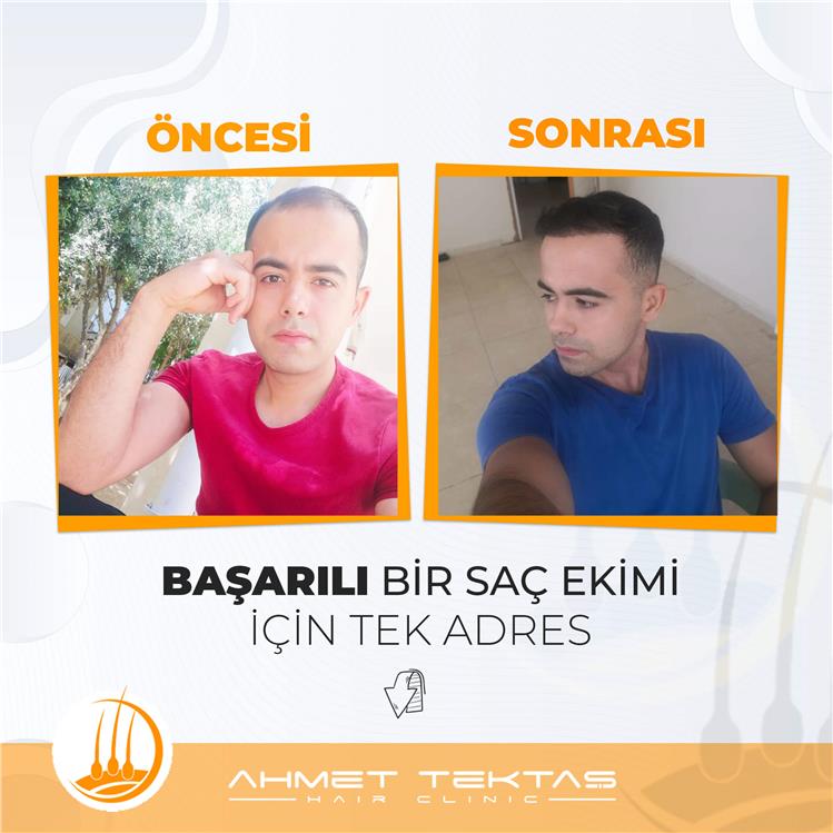Kayseri Saç Ekimi, Serkan Bey