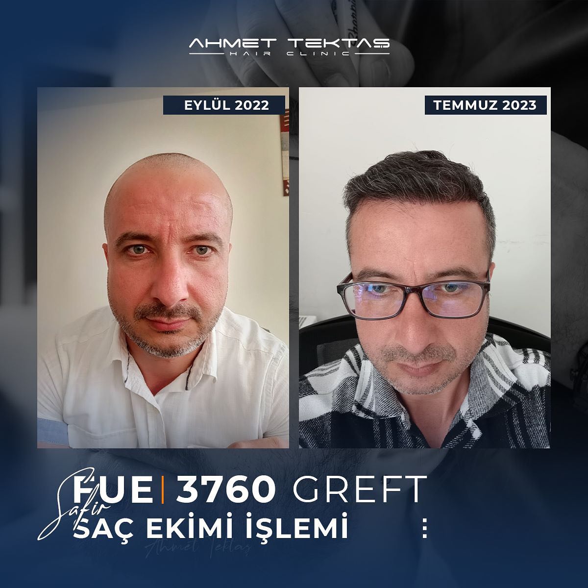 Kayseri Saç Ekimi, Turan Bey