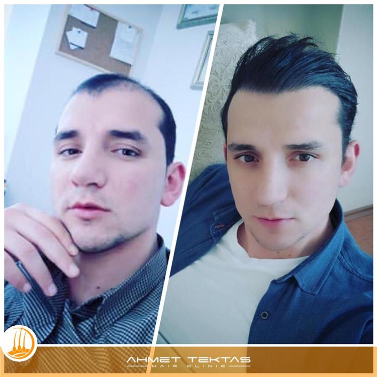 Kayseri Saç Ekimi, Ugur Beyy