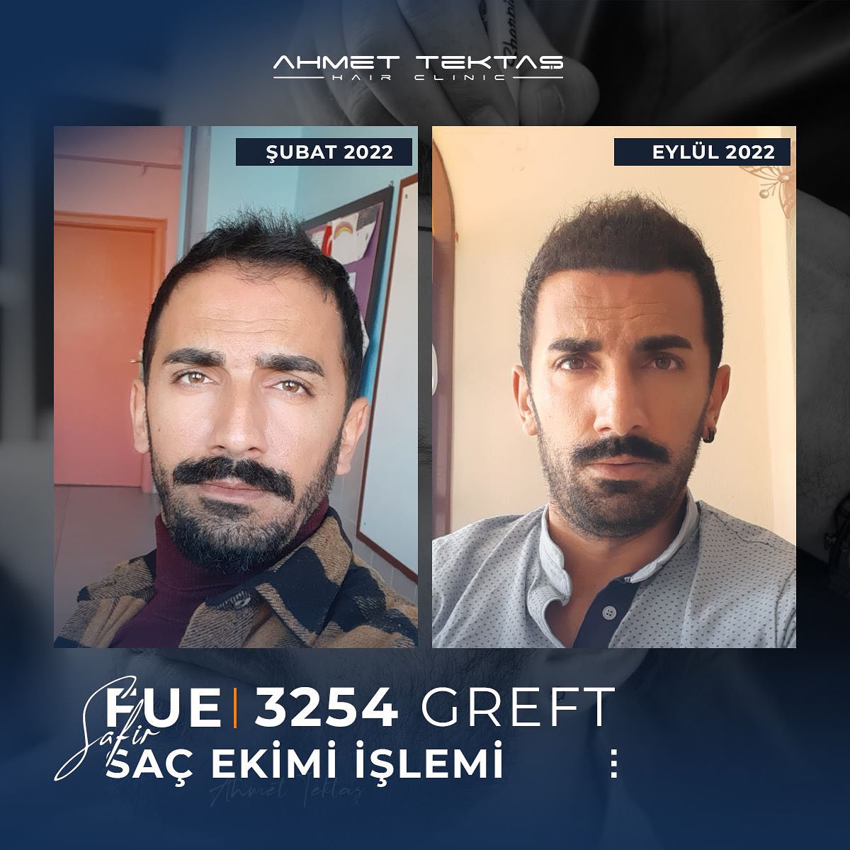 Kayseri Saç Ekimi, Yılmaz Bey