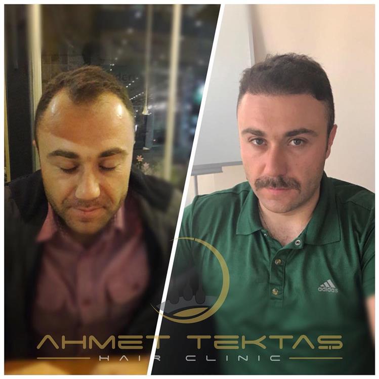 Sivas Saç Ekimi, Hastamız